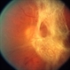 Complications of ARN, TRD